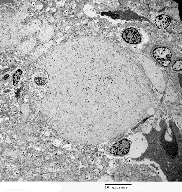 12B2 Focal Cortical Dysplasia (Case 8) balloon cell EM 018 - Copy