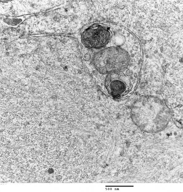 12B3 Focal Cortical Dysplasia (Case 8) balloon cell EM - Copy