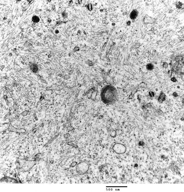 12B4 Focal Cortical Dysplasia (Case 8) balloon cell EM 2 - Copy