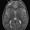 1A3 Focal Cortical Dysplasia (Case 1) MRI T2 1 - Copy