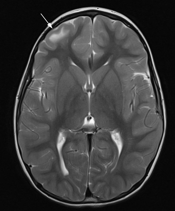 1A3 Focal Cortical Dysplasia (Case 1) MRI T2 1 - Copy