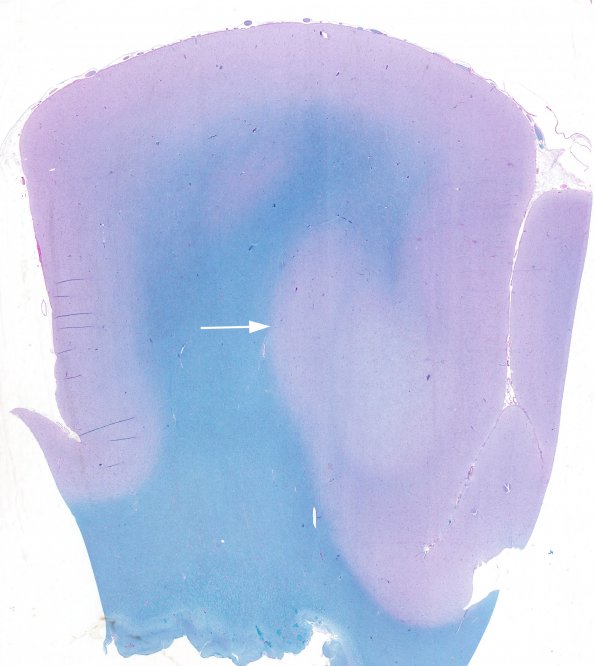 3A2 FCD (Case 5) LFB-PAS whole mount 2