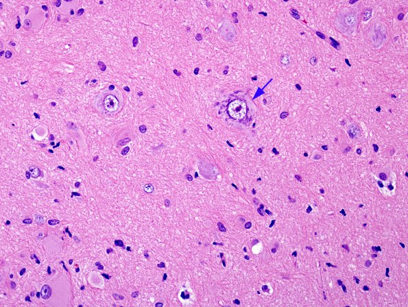 5A1 Focal Cortical Dysplasia (Case 9) H&E 5