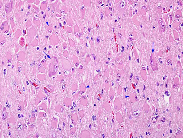 5A6 Focal Cortical Dysplasia (Case 8) H&E 4