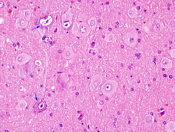 7A1 Focal Cortical Dysplasia (Case 14) H&E 4A