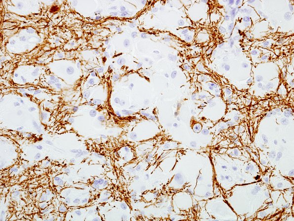 8A5 Focal Cortical Dysplasia (Case 13) NF 4A