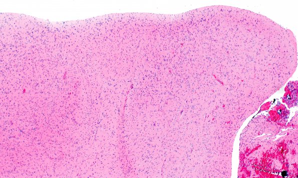 1A1 Focal Cortical dysplasia (Case 1) Ib H&E 1