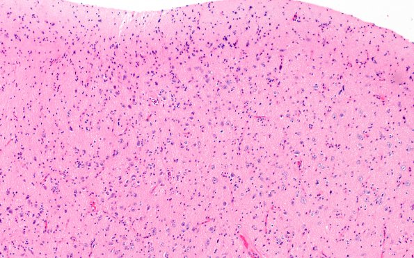 1A2 Focal Cortical dysplasia (Case 1) Ib H&E 2