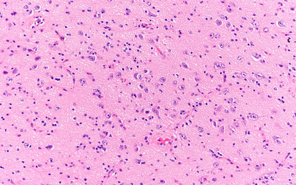 1A3 Focal Cortical dysplasia (Case 1) Ib H&E 4