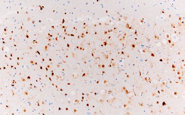 1B1 Focal Cortical dysplasia (Case 1) Ib NeuN 10