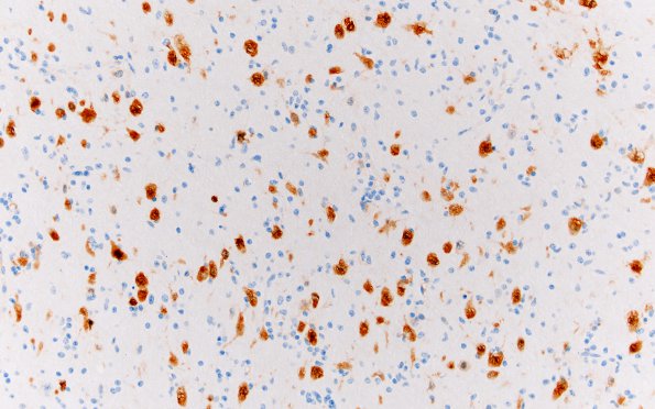 1B3 Focal Cortical dysplasia (Case 1) Ib NeuN 5