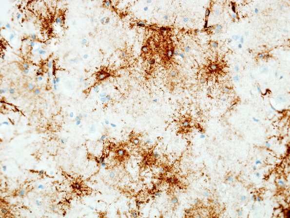 1B4 Focal Cortical dysplasia (Case 1) Ib Spider cells CD 34 2A