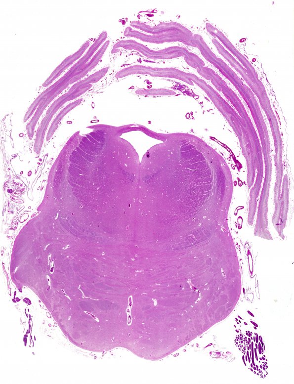 1A1 Aplasia, Granule Cell (Case 1) H&E whole mount 2