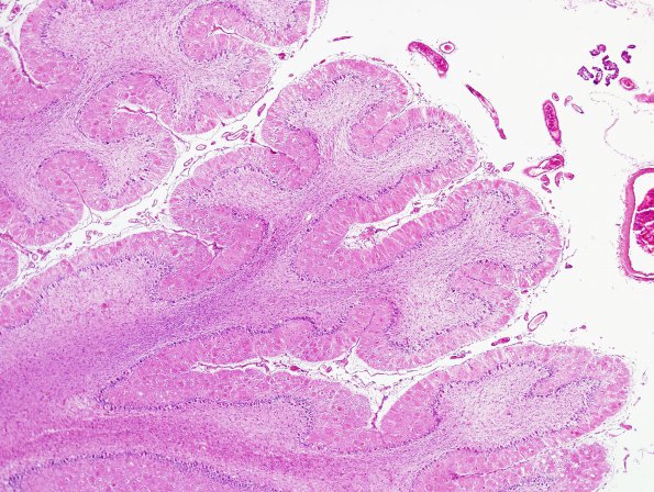 1A2 Aplasia, Granule Cell (Case 1) H&E 3