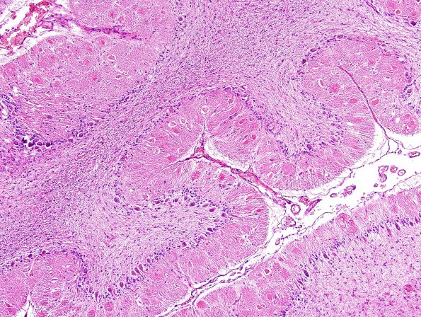 1A3 Aplasia, Granule Cell (Case 1) H&E 2A