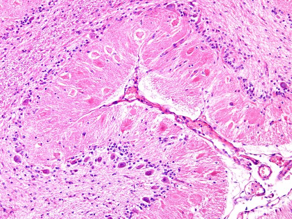 1A4 Aplasia, Granule Cell (Case 1) H&E 1A