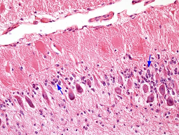 1A5 Aplasia, Granule Cell (Case 1) H&E whole mount 2 (2)