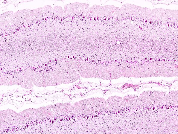 1A6 Aplasia, Granule Cell (Case 1) 10x