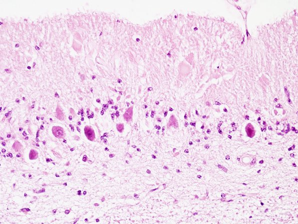 1A7 Aplasia, Granule Cell (Case 1) 40x