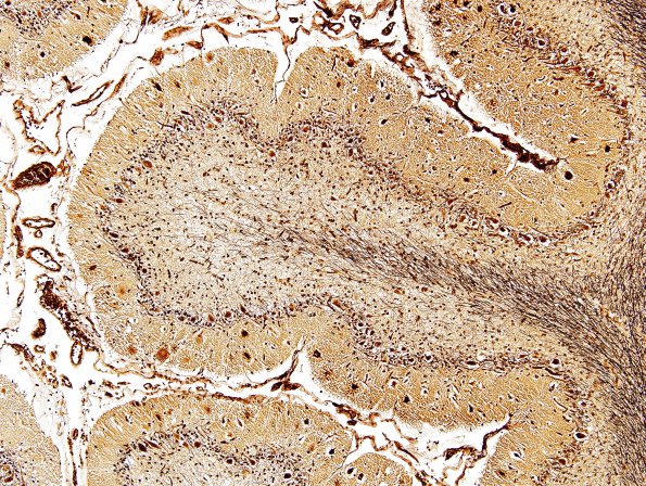 1B1 Aplasia, Granule Cell (Case 1) Biels 3