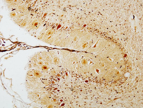 1B2 Aplasia, Granule Cell (Case 1) Biels 1