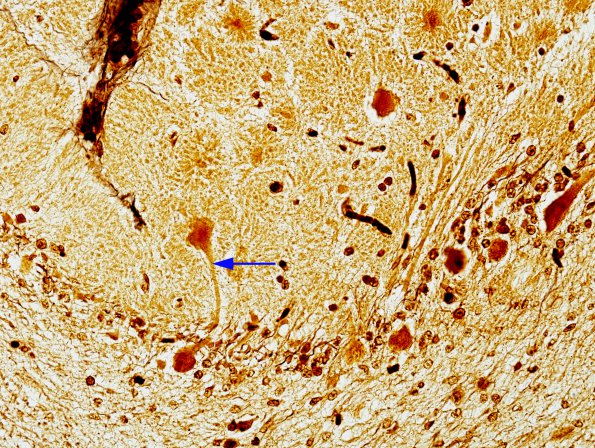 1B3 Aplasia, Granule Cell (Case 1) Biels 2