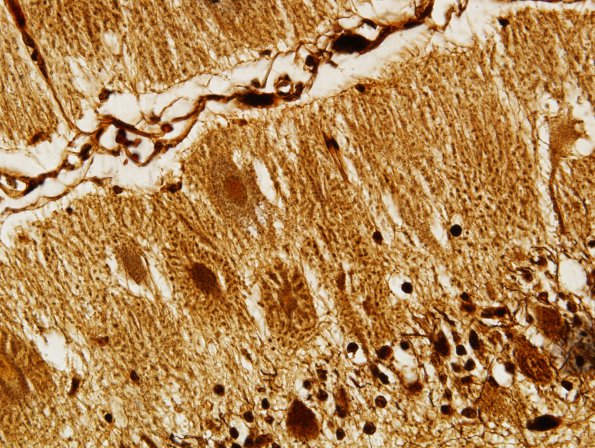 1B4 Aplasia, Granule Cell (Case 1) Biels 60X