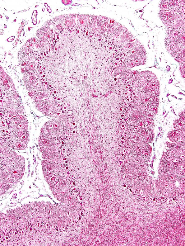 1C1 Aplasia, Granule Cell (Case 1) Trichrome 1