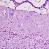 1C2 Aplasia, Granule Cell (Case 1) LFB-PAS 1