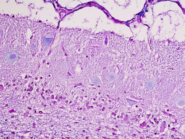 1C2 Aplasia, Granule Cell (Case 1) LFB-PAS 1