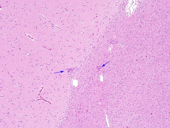 2A1 Hamartia, basal ganglia (Case 2) H&E 1A