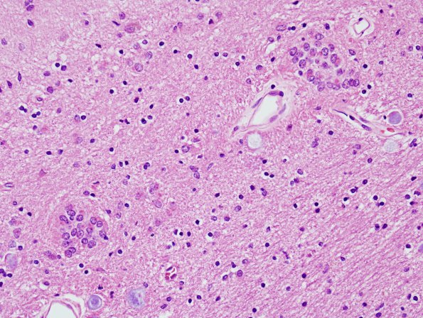 2A2 Hamartia, basal ganglia (Case 2) H&E 3