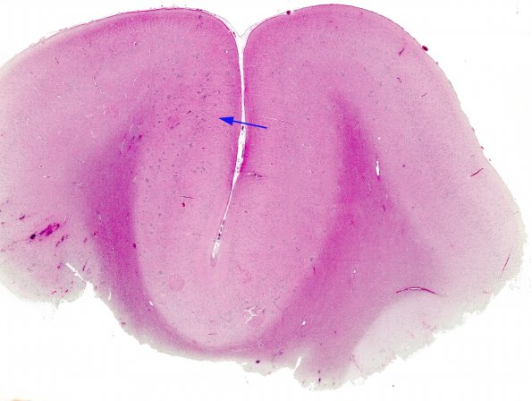 3A1 Hamartia, DNET-associated, (Case 3) H&E whole mount 2