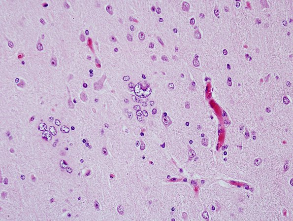 3A5 Hamartia, DNET-associated, (Case 3) H&E 12