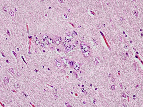 3A6 Hamartia, DNET-associated, (Case 3) H&E 19