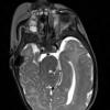 1A1 Hemimegalencephaly (Case 1) T2 STEALTH