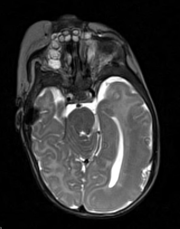 1A1 Hemimegalencephaly (Case 1) T2 STEALTH