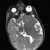 1A2 Hemimegalencephaly (Case 1) T2 2