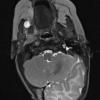 1A3 Hemimegalencephaly (Case 1) T2 1