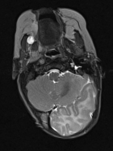 1A3 Hemimegalencephaly (Case 1) T2 1