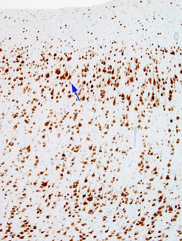 1C2 Hemimegalencephaly (Case 1) A4 NeuN 4