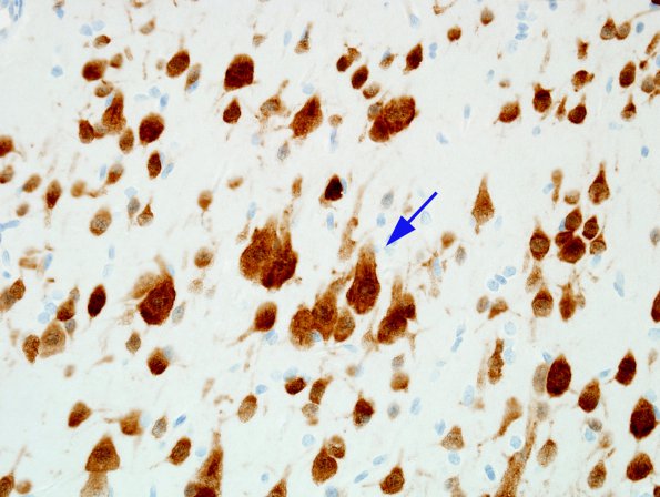 1C3 Hemimegalencephaly (Case 1) A4 NeuN 1