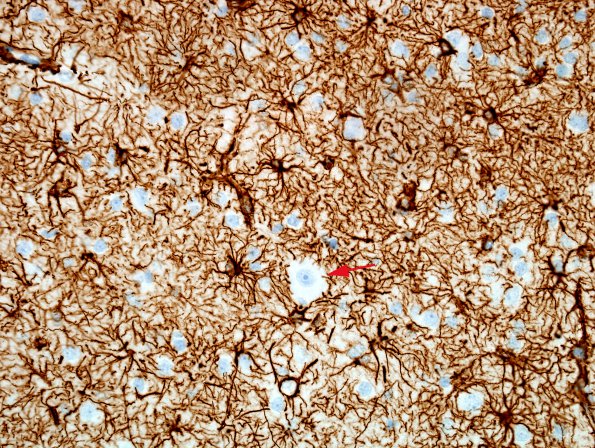 1C4 Hemimegalencephaly (Case 1) A4 GFAP 1