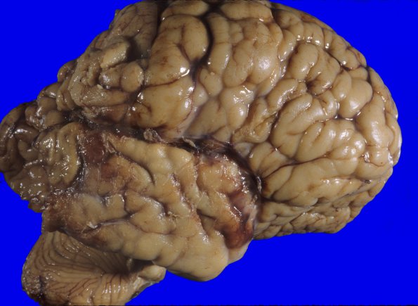 2A1 Hemimegalencephaly (Case 2) 10A