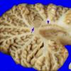 2A10 Hemimegalencephaly (Case 2) 7, Cerebellum heterotopia-heterotaxia A