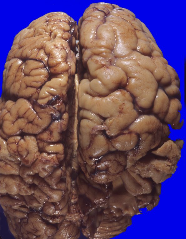 2A2 Hemimegalencephaly (Case 2)  12A