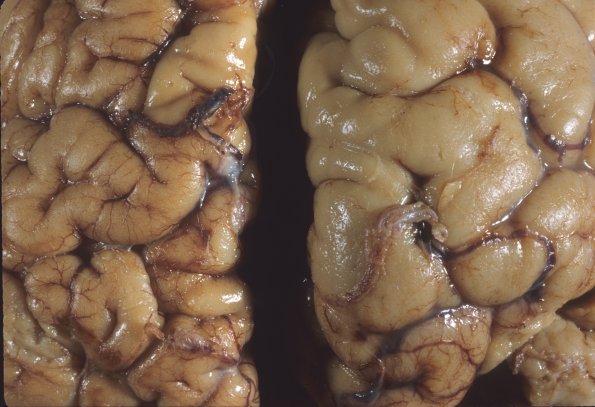 2A3 Hemimegalencephaly (Case 2)  7