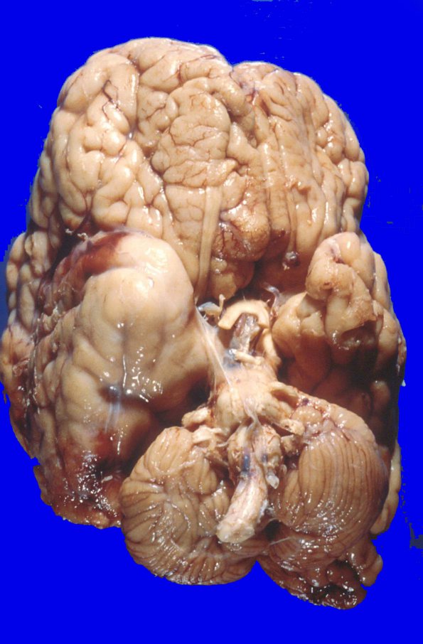 2A4 Hemimegalencephaly (Case 2) 5A