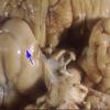 2A5 Hemimegalencephaly (Case 2) 5A