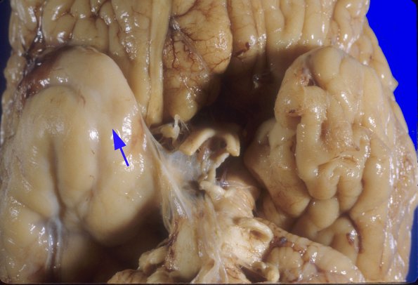 2A5 Hemimegalencephaly (Case 2) 5A